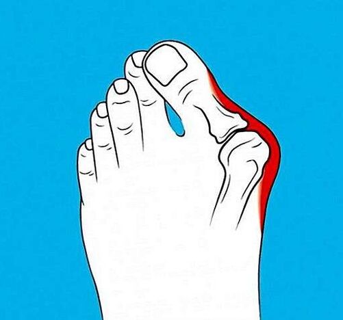 остеоартроз сустава пальца ноги